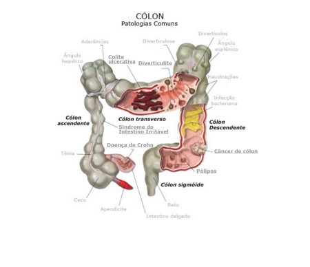 Doença do Colon - Dra. Lucia de Oliveira – Coloproctologista - Clínica ...