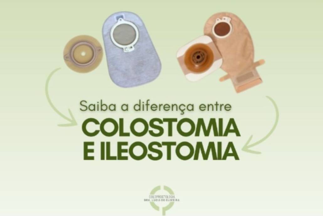 Saiba a Diferença entre Colostomia e Ileostomia