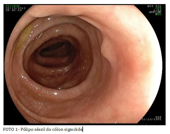colonoscopia_1