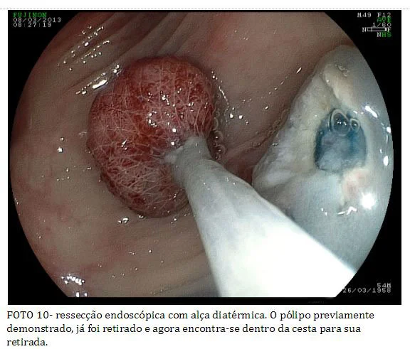 colonoscopia_10