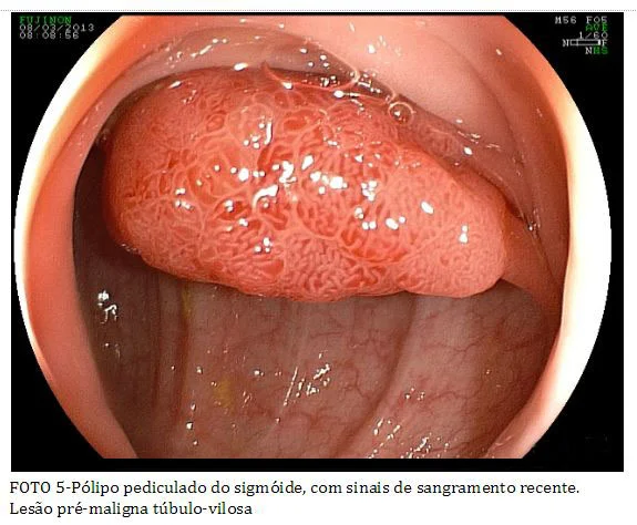 colonoscopia_5