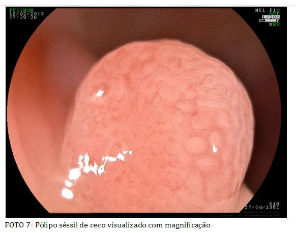 colonoscopia_7