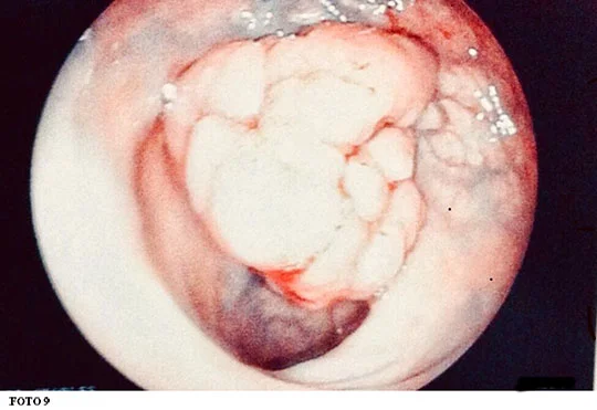 colonoscopia_9