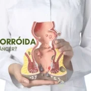Dra. Lucia de Oliveira Hemorroidas podem se transformar em câncer?