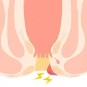 Abscesso Anal e suas consequências Abscesso Anal e suas consequências