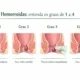 Hemorroidas: graus 1 a 4, sintomas e tratamentos (do consultório à cirurgia)